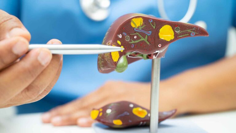 Doctor explaining fatty liver disease using a liver model