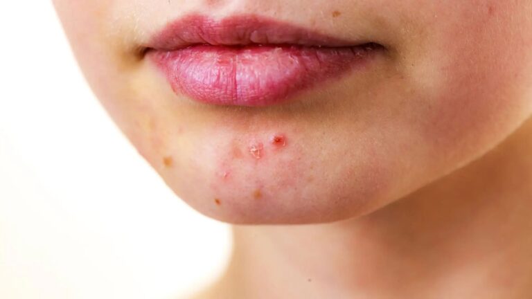 Close-up image showing chin acne and pimples before using pimple patches, illustrating how do pimple patches work to heal breakouts.